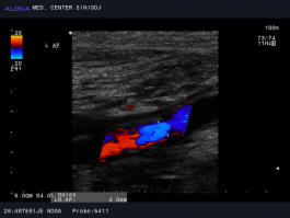 Ultrazvok žil nog - blaga ateroskleroza arterije v kolenu (a. poplitea)